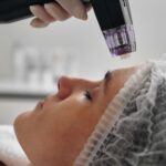 radiofrekwencja mikroigłowa